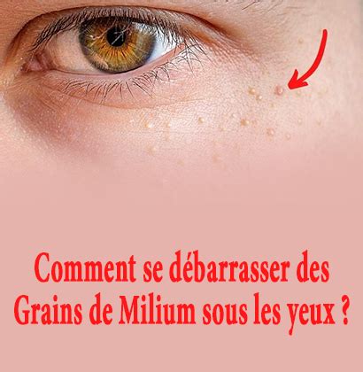 des grains de fordyce|Comment se débarrasser des grains de Fordyce: 12 étapes